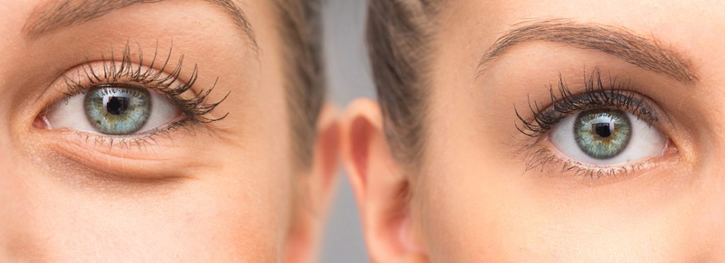 سن ثابت شدن نمره چشم و روشهای ثابت نگه داشتن آن