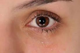 لنز مناسب برای افراد دچار خشکی چشم 